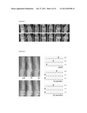  SCORING SYSTEM TO MONITOR NATURAL OR DRUG-MODIFIED DISEASE PROGRESSION IN      EROSIVE OSTEOARTHRITIS  OF THE INTERPHALANGEAL FINGER JOINTS diagram and image