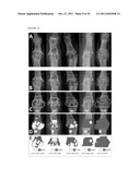  SCORING SYSTEM TO MONITOR NATURAL OR DRUG-MODIFIED DISEASE PROGRESSION IN      EROSIVE OSTEOARTHRITIS  OF THE INTERPHALANGEAL FINGER JOINTS diagram and image