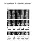  SCORING SYSTEM TO MONITOR NATURAL OR DRUG-MODIFIED DISEASE PROGRESSION IN      EROSIVE OSTEOARTHRITIS  OF THE INTERPHALANGEAL FINGER JOINTS diagram and image