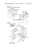 METHOD FOR PRESSURE MEDIATED SELECTIVE DELIVERY OF THERAPEUTIC SUBSTANCES     AND CANNULA diagram and image