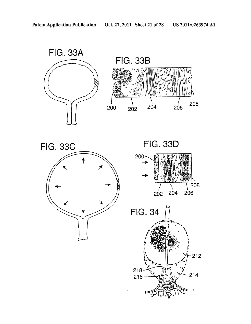 METHOD FOR PRESSURE MEDIATED SELECTIVE DELIVERY OF THERAPEUTIC SUBSTANCES     AND CANNULA - diagram, schematic, and image 22