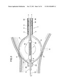 BALLOON CATHETER SYSTEM diagram and image