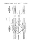 BALLOON CATHETER SYSTEM diagram and image