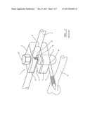 EXTERNAL FIXATION CLAMP diagram and image