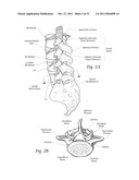 MINIMALLY INVASIVE SYSTEMS, DEVICES, AND SURGICAL METHODS FOR PERFORMING     ARTHRODESIS IN THE SPINE diagram and image