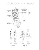 MINIMALLY INVASIVE SYSTEMS, DEVICES, AND SURGICAL METHODS FOR PERFORMING     ARTHRODESIS IN THE SPINE diagram and image