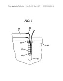 KNOTLESS SUTURE ANCHOR diagram and image