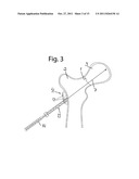 DEVICE FOR FIXATION OF BONE FRAGMENTS AT BONE FRACTURES diagram and image