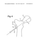 DEVICE FOR FIXATION OF BONE FRAGMENTS AT BONE FRACTURES diagram and image