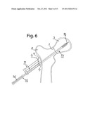 DEVICE FOR FIXATION OF BONE FRAGMENTS AT BONE FRACTURES diagram and image