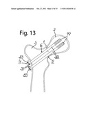 DEVICE FOR FIXATION OF BONE FRAGMENTS AT BONE FRACTURES diagram and image