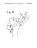 DEVICE FOR FIXATION OF BONE FRAGMENTS AT BONE FRACTURES diagram and image