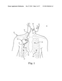 METHOD OF TREATING SLEEP DISORDERED BREATHING diagram and image