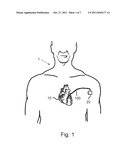 IMPLANTABLE MEDICAL LEAD diagram and image