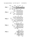 Endoluminal Implant With Locking and Centering Fixation System diagram and image