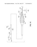 Endoluminal Implant With Locking and Centering Fixation System diagram and image