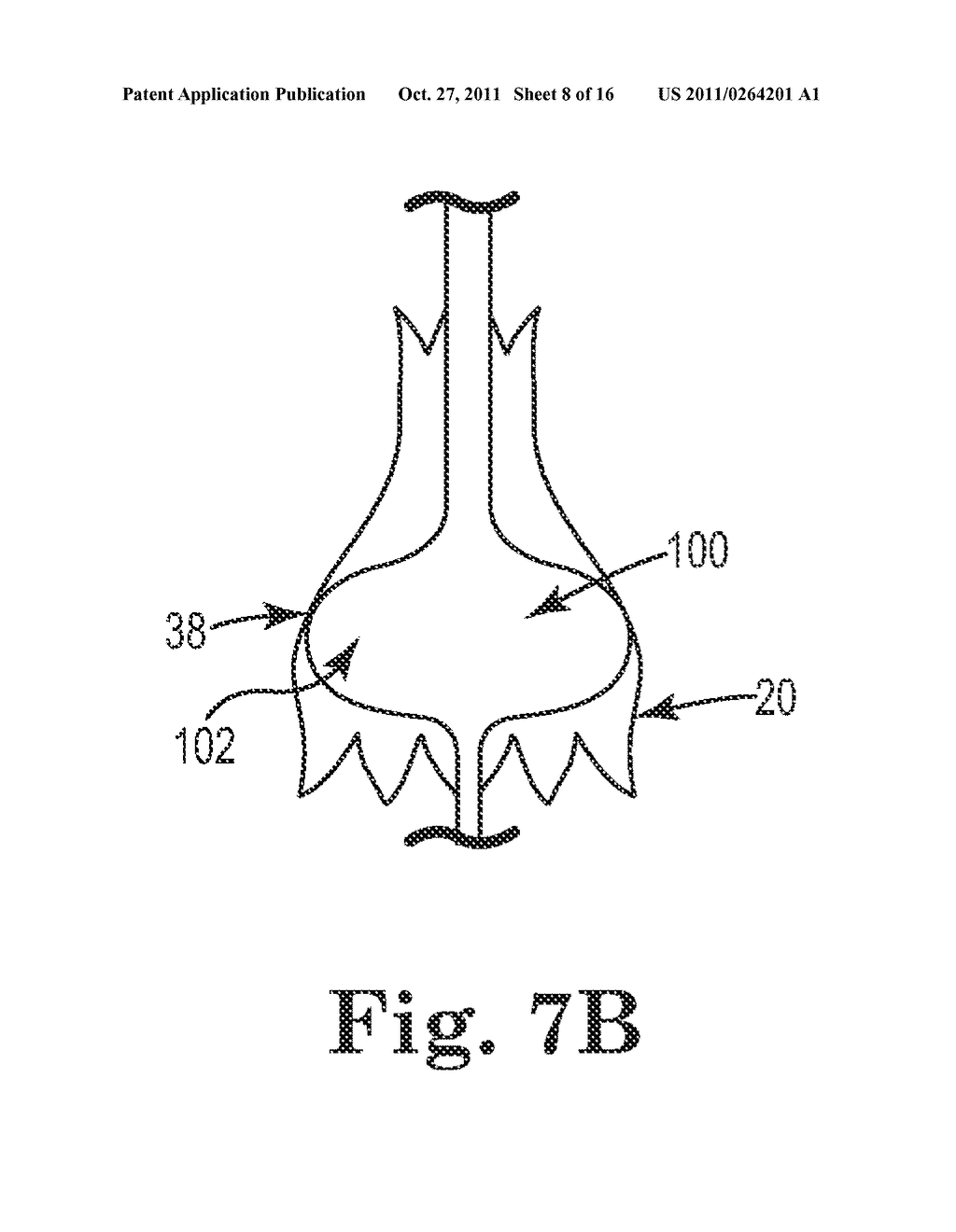 Transcatheter Prosthetic Heart Valve Post-Dilatation Remodeling Devices     and Methods - diagram, schematic, and image 09