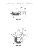 INTERVERTEBRAL BODY IMPLANT, INSTRUMENT AND METHOD diagram and image