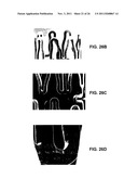 ROTATABLE SUPPORT ELEMENTS FOR STENTS diagram and image