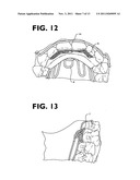 Osteogenetic-Pneumopedic Appliance, System, and Method. diagram and image