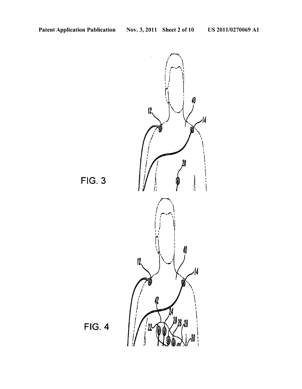 WIRELESS ELECTRODE ARRANGEMENT AND METHOD FOR PATIENT MONITORING VIA     ELECTROCARDIOGRAPHY - diagram, schematic, and image 03