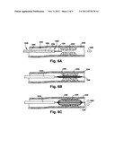 METHOD AND APPARATUS FOR INCREASING BLOOD FLOW THROUGH AN OBSTRUCTED BLOOD     VESSEL diagram and image