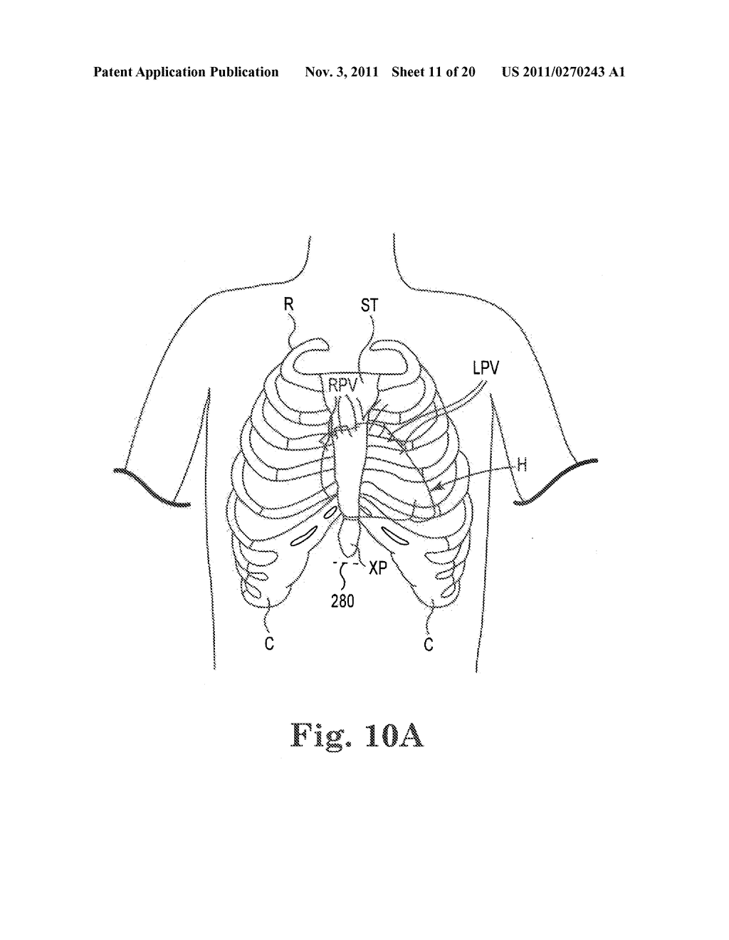 Subxiphoid Connective Lesion Ablation System and Method - diagram, schematic, and image 12