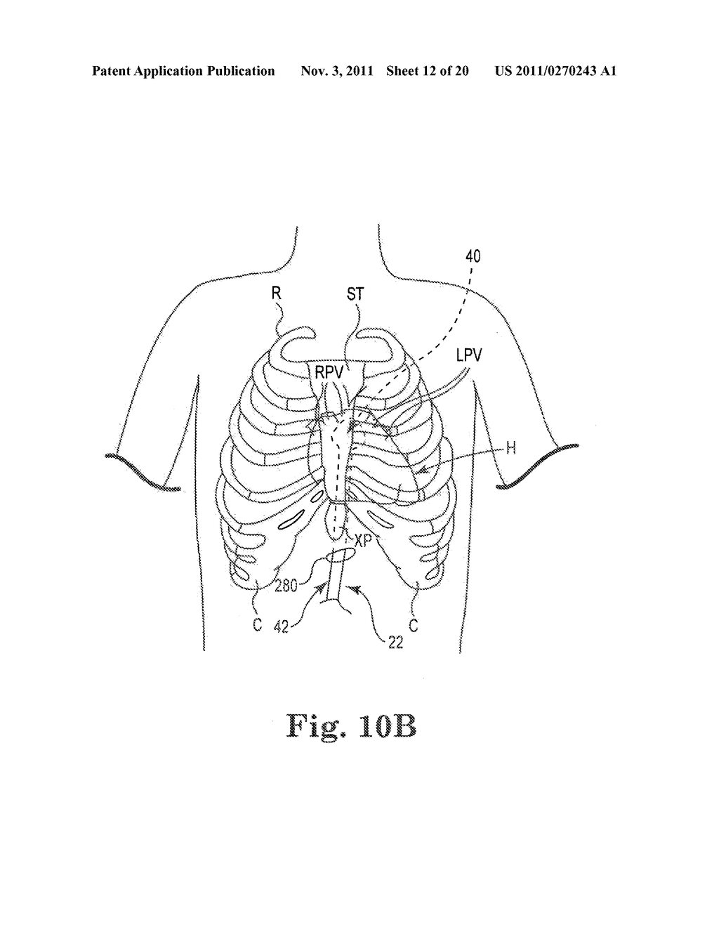 Subxiphoid Connective Lesion Ablation System and Method - diagram, schematic, and image 13