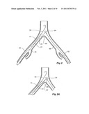 INTRODUCER FOR AN ILIAC SIDE BRANCH DEVICE diagram and image