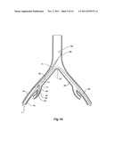 INTRODUCER FOR AN ILIAC SIDE BRANCH DEVICE diagram and image