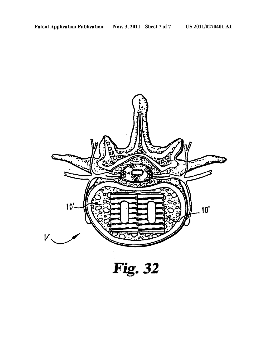 SYNTHETIC REINFORCED INTERBODY FUSION IMPLANTS - diagram, schematic, and image 08