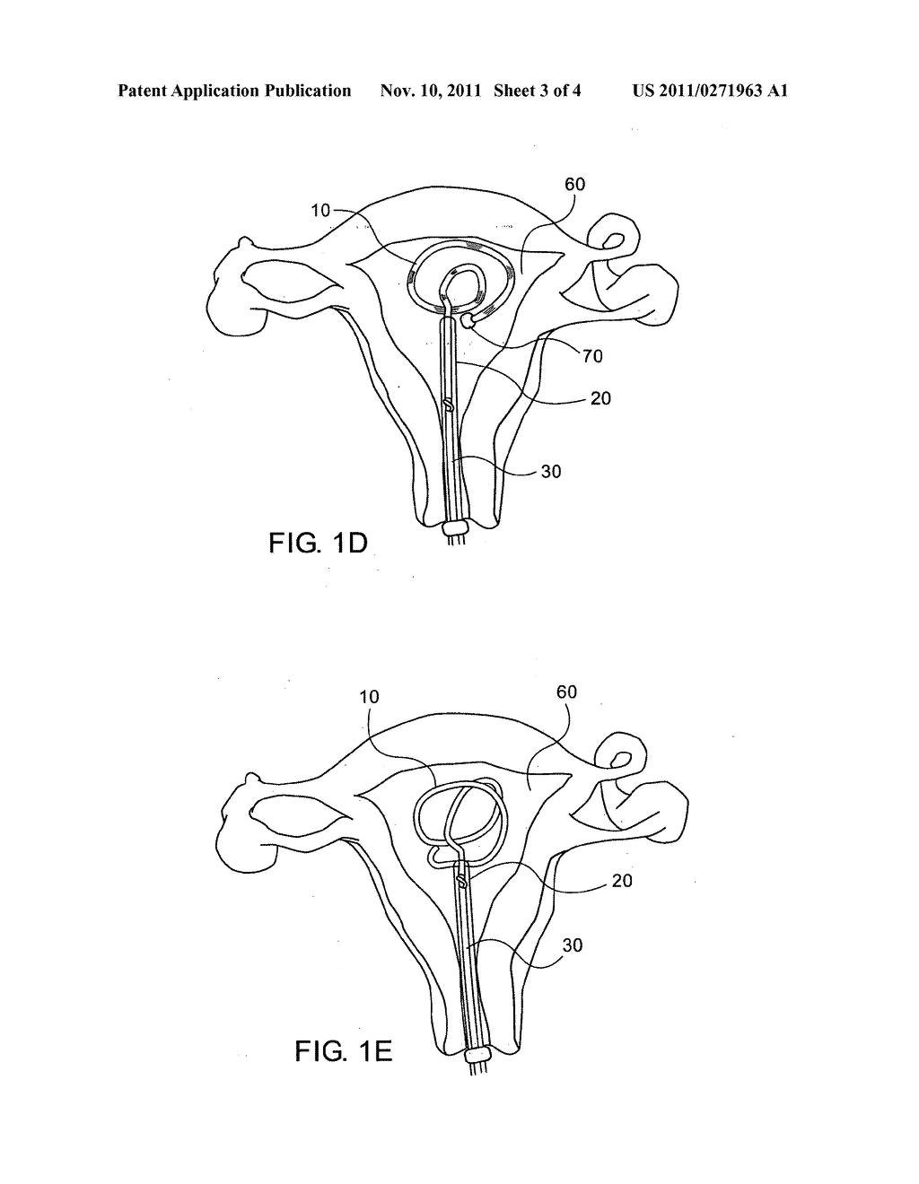 NOVEL INTRA UTERINE DEVICE - diagram, schematic, and image 04