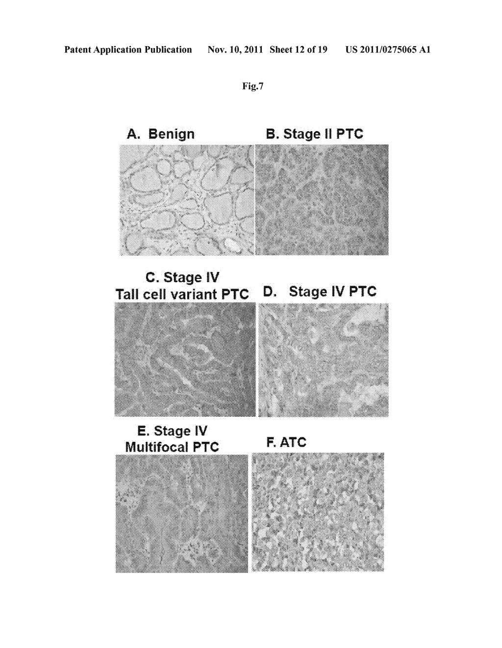 METHODS AND COMPOSITIONS FOR THE DIAGNOSIS AND TREATMENT OF THYROID CANCER - diagram, schematic, and image 13