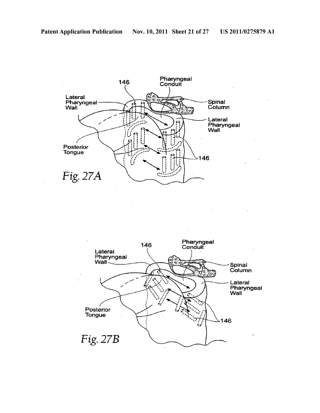 MAGNETIC FORCE DEVICES, SYSTEMS, AND METHODS FOR RESISTING TISSUE COLLAPSE     WITHIN THE PHARYNGEAL CONDUIT - diagram, schematic, and image 22