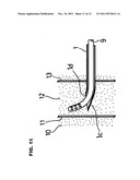 ANESTHETIC COMPOUND NEEDLE diagram and image