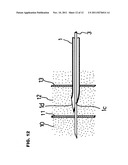 ANESTHETIC COMPOUND NEEDLE diagram and image