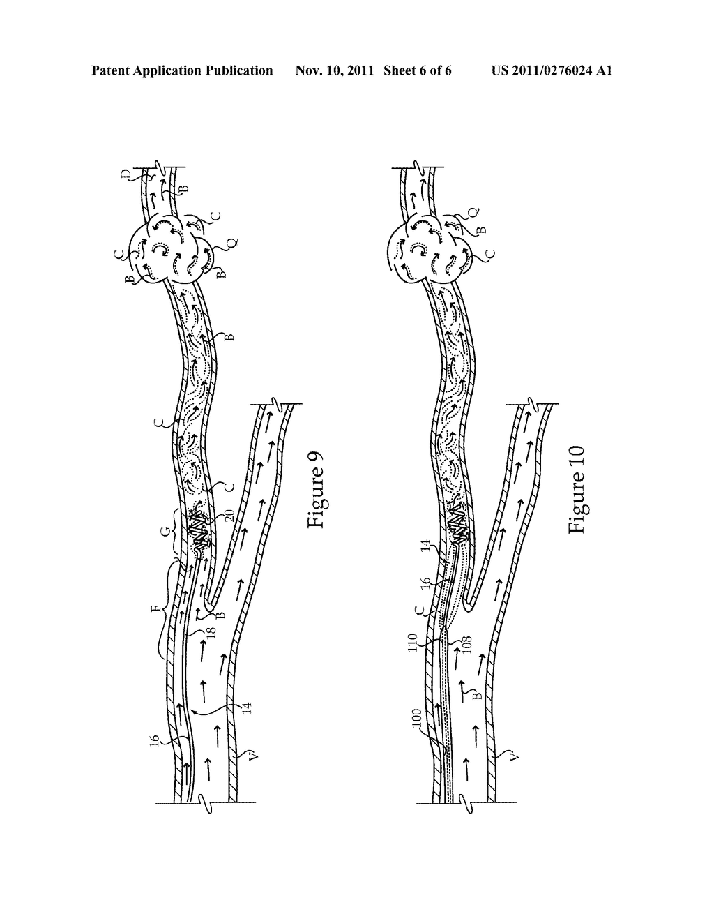 Treatment Fluid Delivery Method, And Turbulator For Promoting Uptake Of A     Treatment Agent - diagram, schematic, and image 07