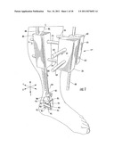 Method of Preparing an Ankle Joint for Replacement, Joint Prosthesis, and     Cutting Alignment Apparatus for Use in Performing an Arthroplasty     Procedure diagram and image