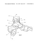 Method of Preparing an Ankle Joint for Replacement, Joint Prosthesis, and     Cutting Alignment Apparatus for Use in Performing an Arthroplasty     Procedure diagram and image