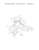 Method of Preparing an Ankle Joint for Replacement, Joint Prosthesis, and     Cutting Alignment Apparatus for Use in Performing an Arthroplasty     Procedure diagram and image