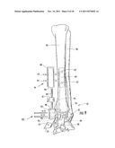 Method of Preparing an Ankle Joint for Replacement, Joint Prosthesis, and     Cutting Alignment Apparatus for Use in Performing an Arthroplasty     Procedure diagram and image