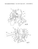 Method of Preparing an Ankle Joint for Replacement, Joint Prosthesis, and     Cutting Alignment Apparatus for Use in Performing an Arthroplasty     Procedure diagram and image