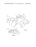 Method of Preparing an Ankle Joint for Replacement, Joint Prosthesis, and     Cutting Alignment Apparatus for Use in Performing an Arthroplasty     Procedure diagram and image