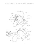 Method of Preparing an Ankle Joint for Replacement, Joint Prosthesis, and     Cutting Alignment Apparatus for Use in Performing an Arthroplasty     Procedure diagram and image