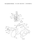 Method of Preparing an Ankle Joint for Replacement, Joint Prosthesis, and     Cutting Alignment Apparatus for Use in Performing an Arthroplasty     Procedure diagram and image