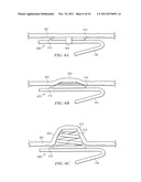 Anchors with Biodegradable Constraints diagram and image