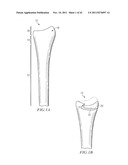 System for Treating Bone Fractures diagram and image