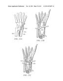 System for Treating Bone Fractures diagram and image