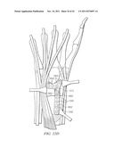 System for Treating Bone Fractures diagram and image