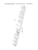 System for Treating Bone Fractures diagram and image